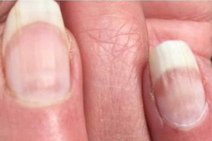 ایجاد شیار و خطوط روی ناخن‌ها در بسیاری از بهبودیافتگان کرونا دیده شده است و برخی آن را از عوارض این بیماری می‌دانند، در حالی‌که مطالعات نشان می‌دهد این عارضه منحصر به کووید نیست و می‌تواند پس از هرگونه عفونت ویروسی بروز کند.