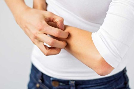 چگونه از اگزما در فصل گرما جلوگیری کنیم؟