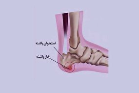 دردی تیز و تیرکشنده در پاشنه پا