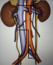 عمل جراحی برداشتن غدد لنفاوی خلف صفاق به صورت لاپاروسکوپی در کرمان                        