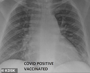 تفاوت ریه فرد واکسینه شده با فرد واکسینه نشده (تصاویر)
