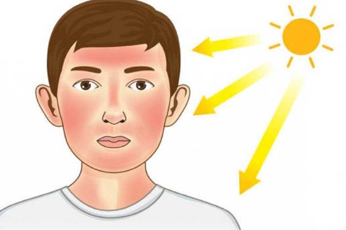 پس از ابتلا به آفتاب سوختگی، برای ممانعت از بدتر شدن وضعیت پوست، برخی کار‌ها را نباید انجام دهید.