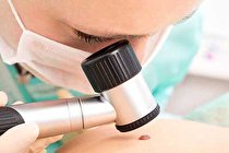 درمان ملانوم با آنتی‌ بیوتیک