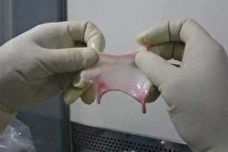 غضروف بینی آرتروز زانو را درمان کرد