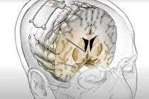 درمان افسردگی با تحریک عمیق مغزی