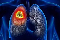 روغن کانابیدیول می تواند تومورهای سرطان ریه را کوچک کند