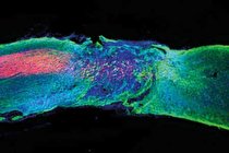 معجزه درمان آسیب‌ های نخاعی