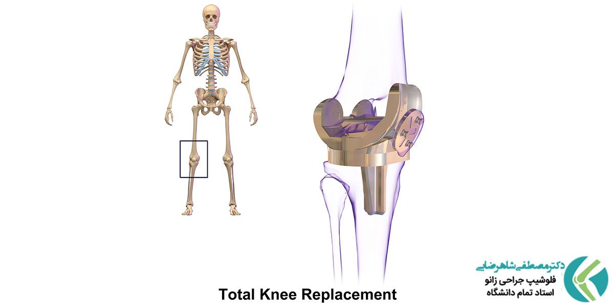 تعویض مفصل زانو در تهران