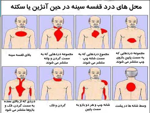 علائم انواع سکته قلبی چیست؟ علائم انواع سکته قلبی چیست؟