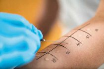 حساسیت‌ زدایی با آزمایش آلرژی‌