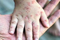 دوره پنهان سرخک ۲ هفته است / علائم بیماری با تب ظاهر می شود