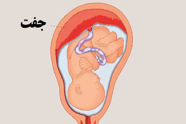 جدید ترین راه درمان آرتروز زانو با سلول جفت یا Arthrocell