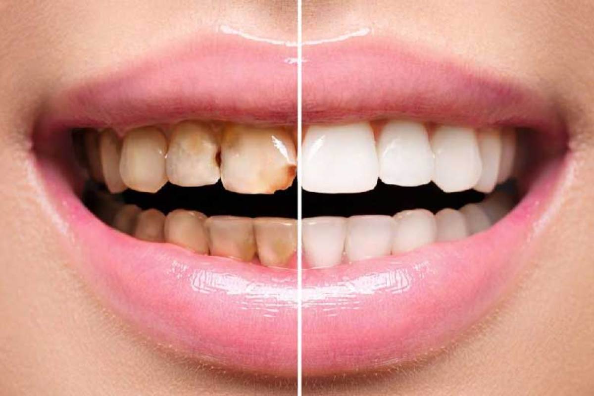 در این مقاله به برخی از مزایای ونیر دندان اشاره خواهیم کرد.