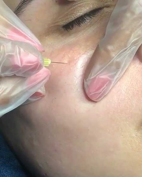 11 روش درمان میلیا چیست؟(درمان پزشکی و خانگی) 11 روش درمان میلیا چیست؟(درمان پزشکی و خانگی)