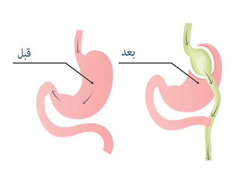 بهترین روش درمان چاقی مفرط چیست؟ بهترین روش درمان چاقی مفرط چیست؟