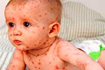 سرخک مسری ترین بیماری واگیر در دنیاست