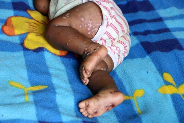 تغییر در الگوی ابتلا و نشانه‌های بیماری | تشکیل کمیته کشوری مبارزه با آبله میمون