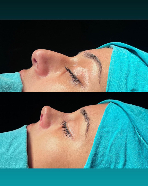 جراحی بینی گوشتی چیست؟ | مراحل، هزینه، مزایا و عوارض جراحی بینی