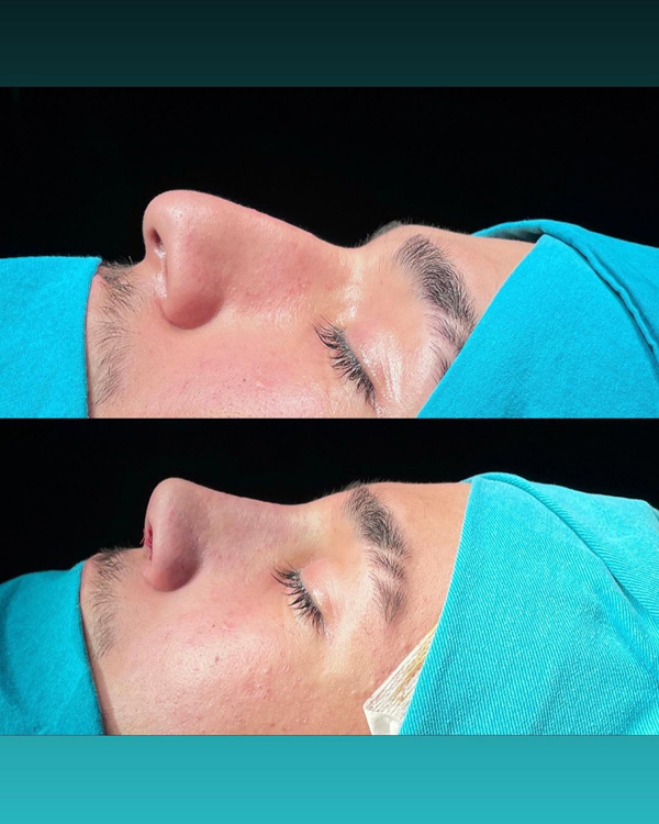 جراحی بینی گوشتی چیست؟ | مراحل، هزینه، مزایا و عوارض نمونه عمل بینی