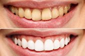 انواع روش های سفید کردن دندان ها