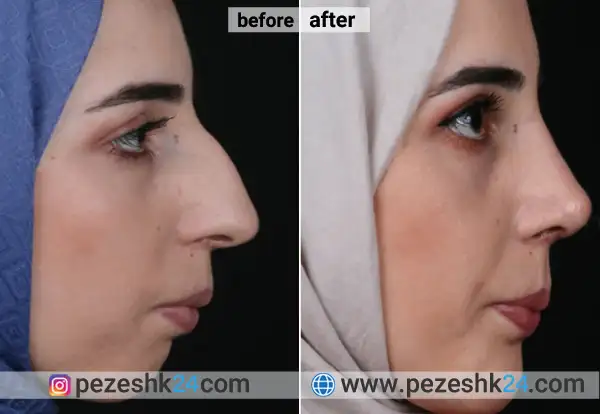 درد عمل بینی استخوانی بیشتره یا گوشتی درد عمل بینی استخوانی بیشتره یا گوشتی