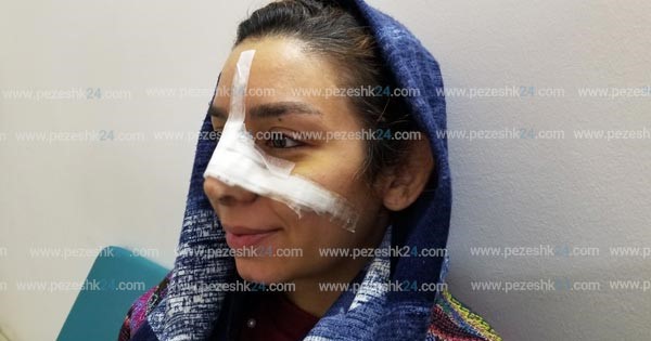 درد عمل بینی استخوانی بیشتره یا گوشتی درد عمل بینی استخوانی بیشتره یا گوشتی