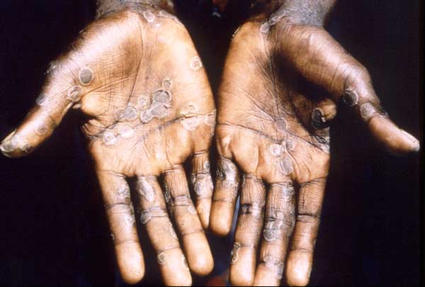  آبله میمون خیلی دور، خیلی نزدیک | درخواست تهیه واکسن برای کادر درمان  آبله میمون خیلی دور، خیلی نزدیک | درخواست تهیه واکسن برای کادر درمان