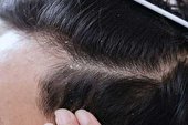 ببینید | علت شوره زدن موی سر چیست؟