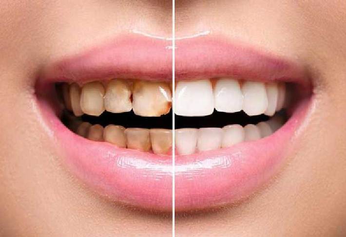 لمینت پرسلن و رزین کامپوزیت رایج ترین مواد برای ساخت روکش های دندانی هستند. در صورتی که به یک دندانپزشک زیبایی با تجربه مراجعه کنید با هر دوی این مواد می تواند لبخندی زیبا به شما هدیه دهد.