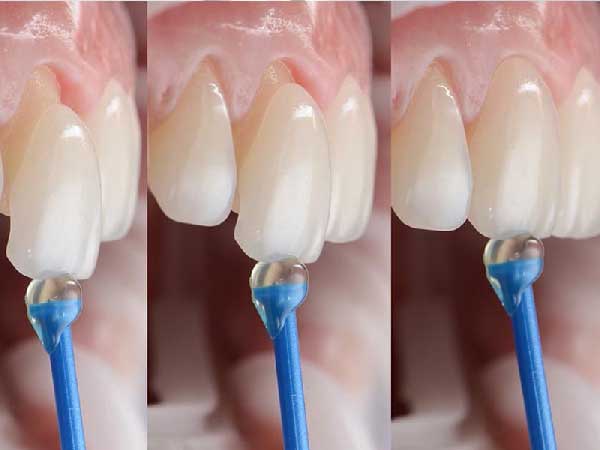 لمینت دندان بهتر است یا کامپوزیت لمینت دندان بهتر است یا کامپوزیت