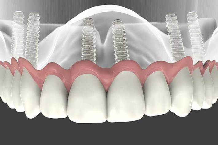 زمانی که شما با افزایش سن دچار از دست رفتگی تمام دندان­هایتان شده­اید، بهترین روش برای جایگزینی دندان­های از دست رفته ­تان ایمپلنت کامل است.