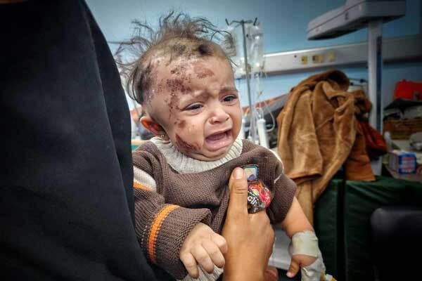 عکس | معلولیتهای کودکان فلسطینی در نتیجه حملات اشغالگران به غزه عکس | معلولیتهای کودکان فلسطینی در نتیجه حملات اشغالگران به غزه