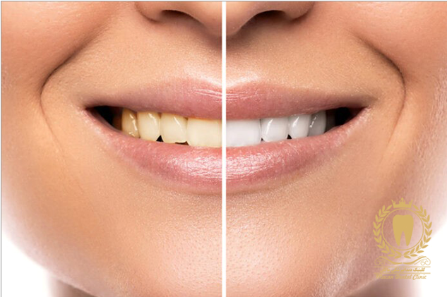 عصب کشی دندان در کلینیک دندانپزشکی تخصصی ماکان عصب کشی دندان در کلینیک دندانپزشکی تخصصی ماکان