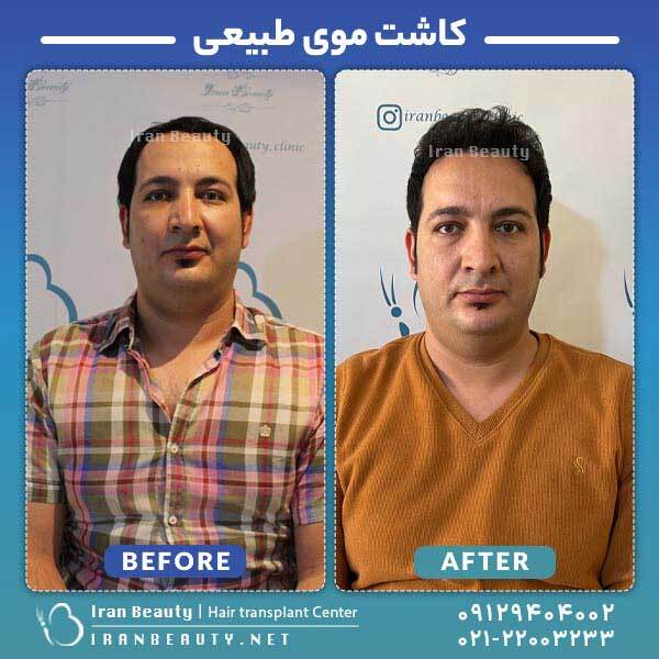 کاشت مو به روش DHI چگونه انجام میشود؟ کاشت مو به روش DHI چگونه انجام میشود؟