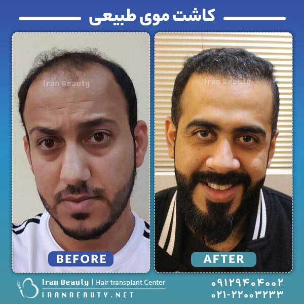 کاشت مو به روش DHI چگونه انجام میشود؟ کاشت مو به روش DHI چگونه انجام میشود؟