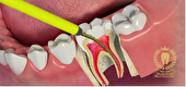 عصب کشی دندان در کلینیک دندانپزشکی تخصصی ماکان