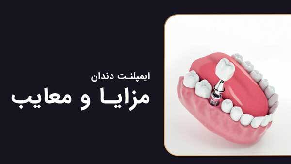 هر آنچه باید درباره ایمپلنت دندان بدانید: از ترس تا اعتماد هر آنچه باید درباره ایمپلنت دندان بدانید: از ترس تا اعتماد