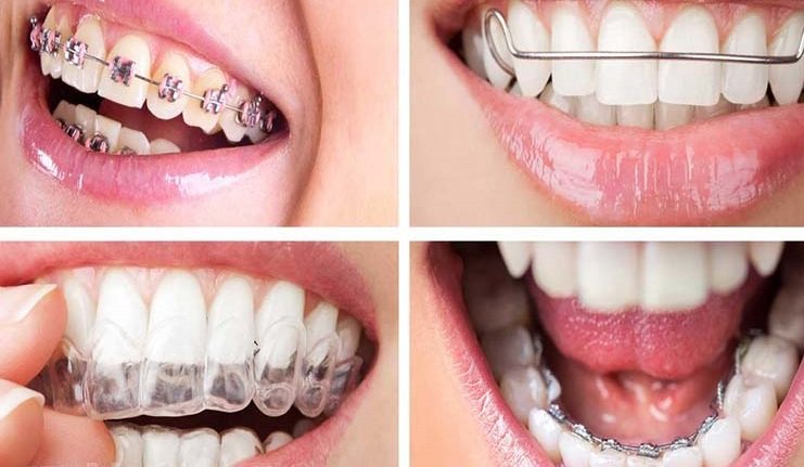 چطور می توانیم لبخندی زیبا داشته باشیم؟ چطور می توانیم لبخندی زیبا داشته باشیم؟