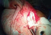 خارج کردن کیست ۱۵ کیلویی از شکم بانوی ۲۲ ساله میبدی