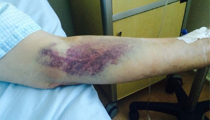 ابتلای 19 نفر به ‌تب کریمه کنگو | نشانه‌های ابتلا به بیماری