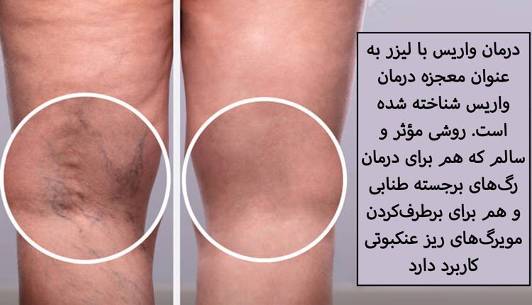 نکات کلیدی پس از عمل واریس پا با لیزر