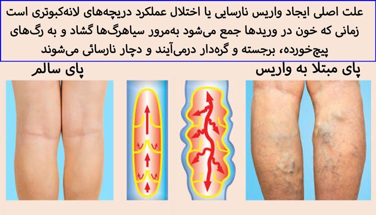 نکات کلیدی پس از عمل واریس پا با لیزر
