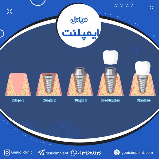 ایمپلنت دندان چیست و چقدر هزینه دارد؟
