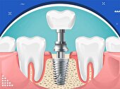 ایمپلنت دندان چیست و چقدر هزینه دارد؟