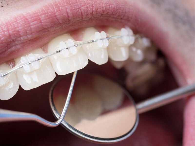 درمان نامرتبی دندانها با ارتودنسی سرامیکی درمان نامرتبی دندانها با ارتودنسی سرامیکی