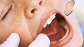 ببینید | علائم بیماری سنگ لوزه