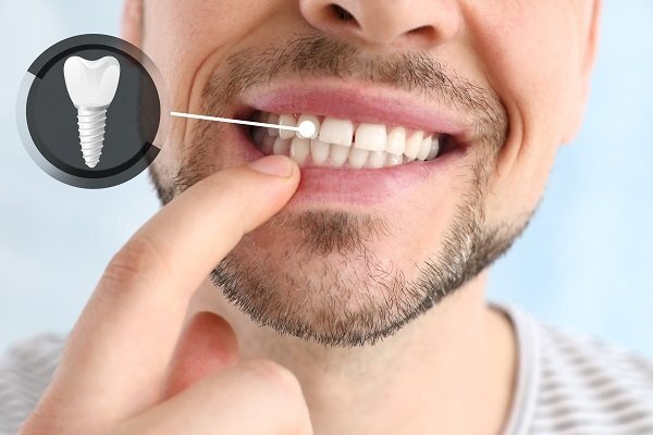 چگونه هزینههای دندانپزشکی را کاهش دهیم؟ چگونه هزینههای دندانپزشکی را کاهش دهیم؟