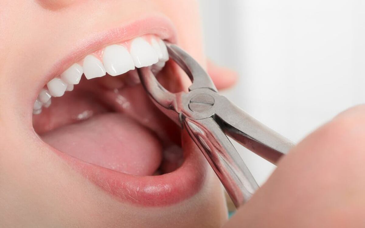 کشیدن دندان یک عمل رایج است که می‌تواند به تسکین درد و ناراحتی ناشی از دندان‌های آسیب دیده یا عفونی کمک کند. با این حال، طبیعی است که بعد از کشیدن دندان احساس درد داشته باشید.