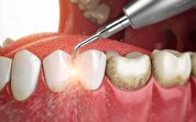 جرم‌گیری تاثیر منفی بر مینا و ریشه دندان‌ها ندارد