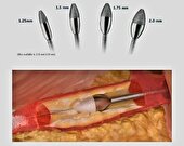 الماس چرخنده، رسوب کلیسم رگ‌ها را بدون نیاز به عمل جراحی باز از بین می‌برد 